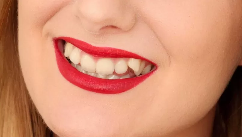 Например, если у вас скученность зубов на нижней челюсти или выпирает клык на верхней, то внешне в этих местах в области губ будет асимметрия лица